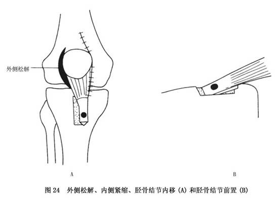 女孩天生髌骨脱位，髌骨脱位遗传吗?