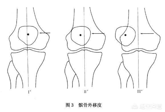 女孩天生髌骨脱位，髌骨脱位遗传吗?