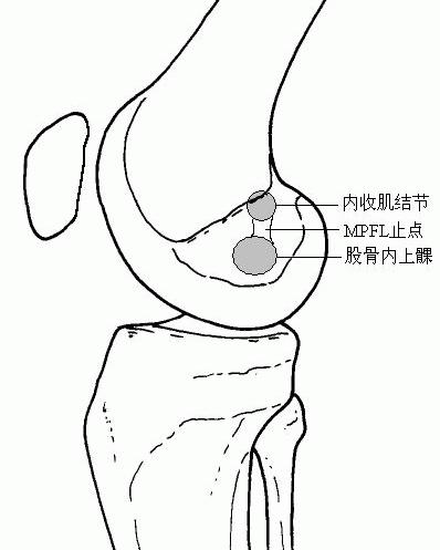 女孩天生髌骨脱位，髌骨脱位遗传吗?