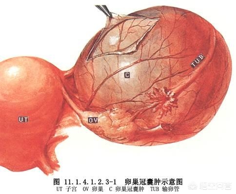 卵巢囊肿取出重5.8斤，摘除卵巢囊肿