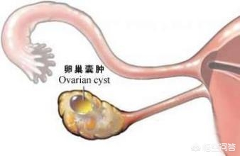 卵巢囊肿取出重5.8斤，摘除卵巢囊肿